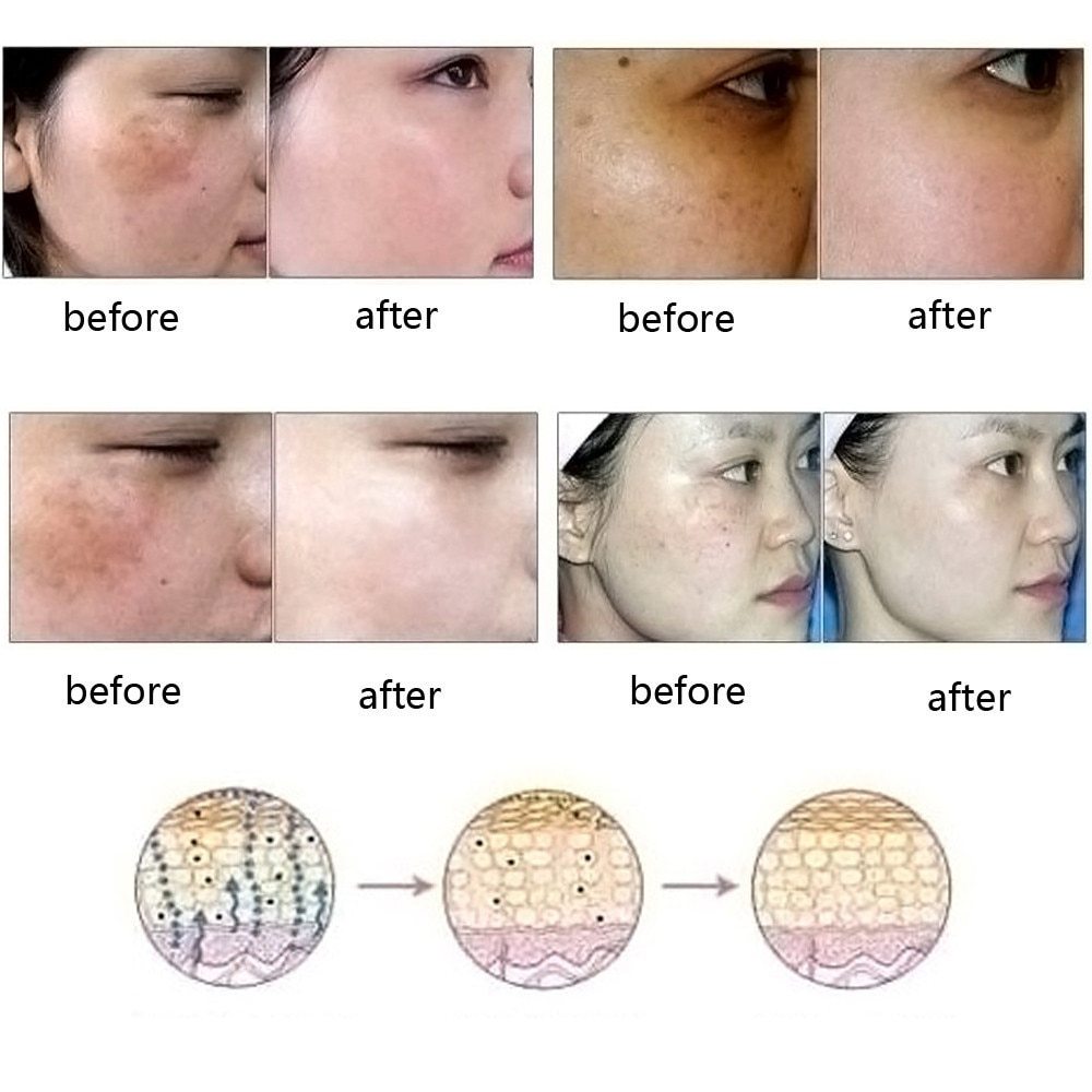 Dredge Meridian Skin Care Natural Pure Acne Removal Stretch Marks Removal Scar Removal Essence oil - Mag Max Mart