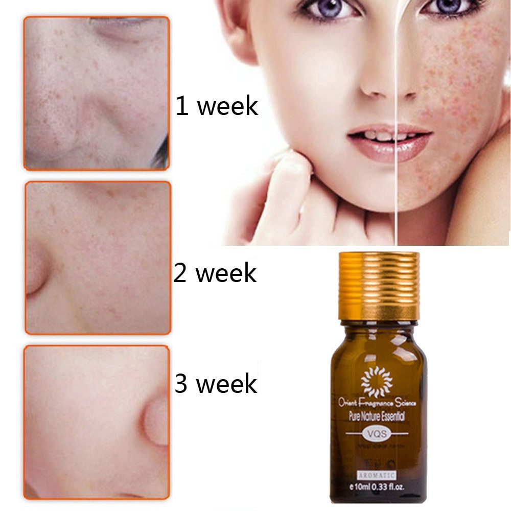 Dredge Meridian Skin Care Natural Pure Acne Removal Stretch Marks Removal Scar Removal Essence oil - Mag Max Mart