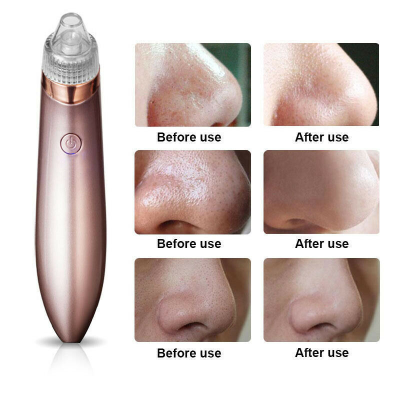 Electric Blackhead Vacuum Pore Cleaner Acne Pimple Remover Strong Suction Tool Electric Blackhead Remover Pore Vacuum Suction Diamond Dermabrasion Face Cleaner - MAGM Enterprises LLC