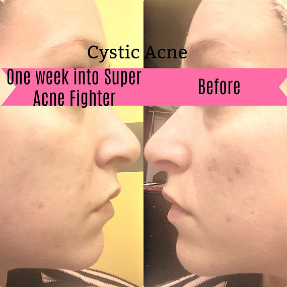 Super Acne Fighter / Organic Acne Treatment / Acne Cleanser - MAGM Enterprises LLC